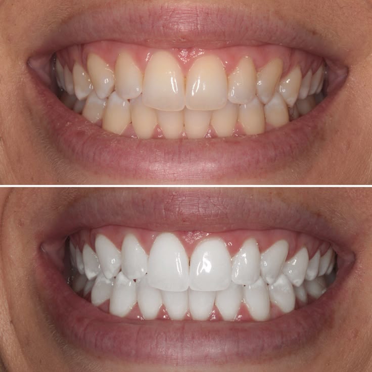 Teeth after whitening